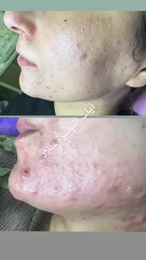 جلسة واحدة علاج بشرة دهنية kb pure 👏