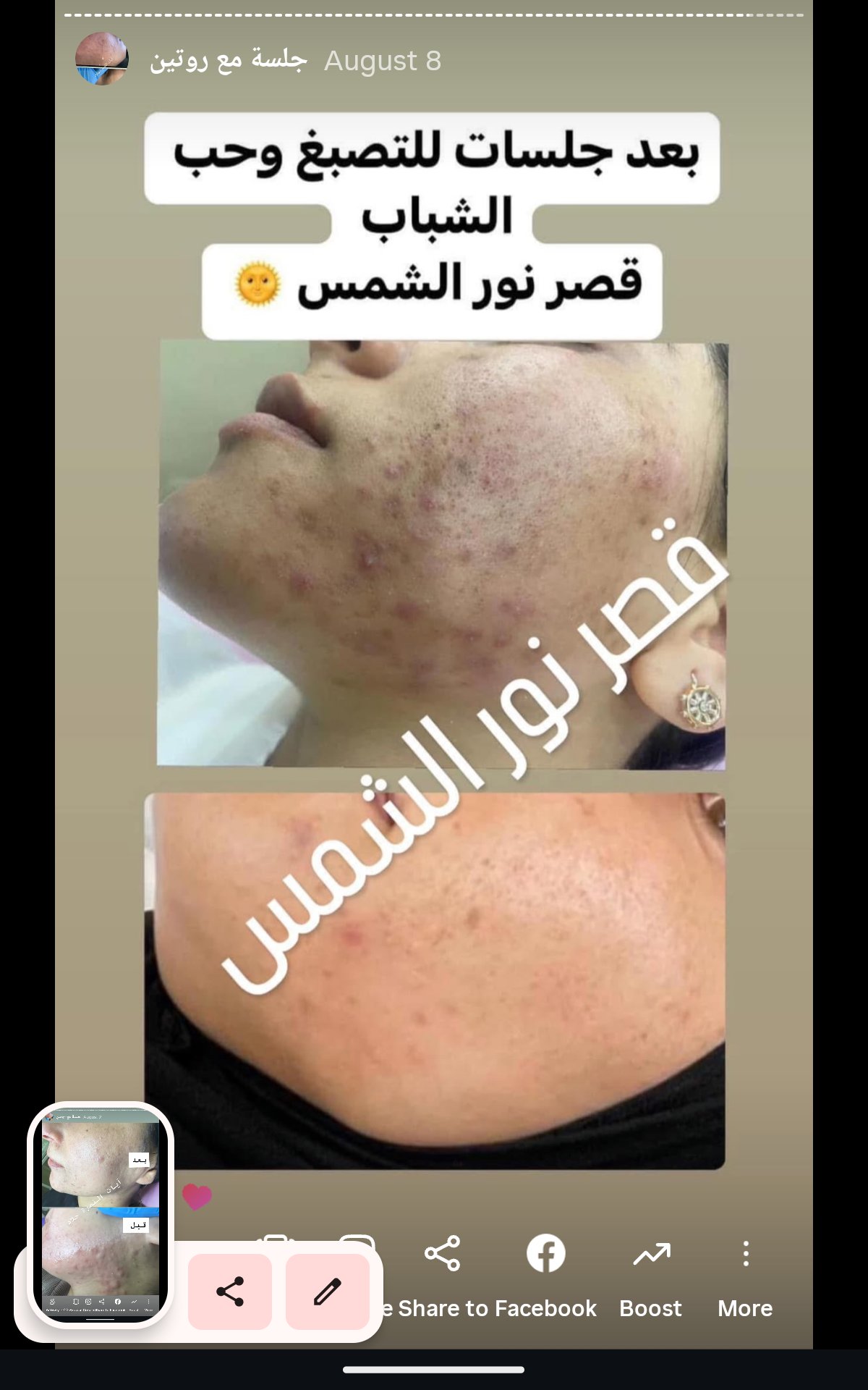 نتائج جلسات حب الشباب